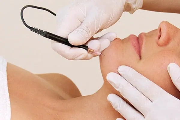 Electrolysis Hair Removal (1 hour session)